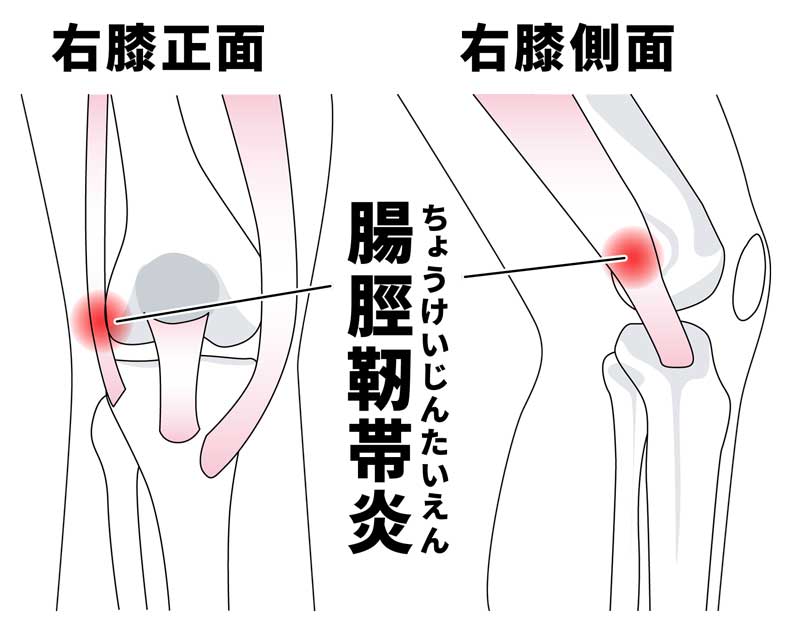 膝のお皿の外側の痛み（ランナー膝・腸脛靭帯炎）