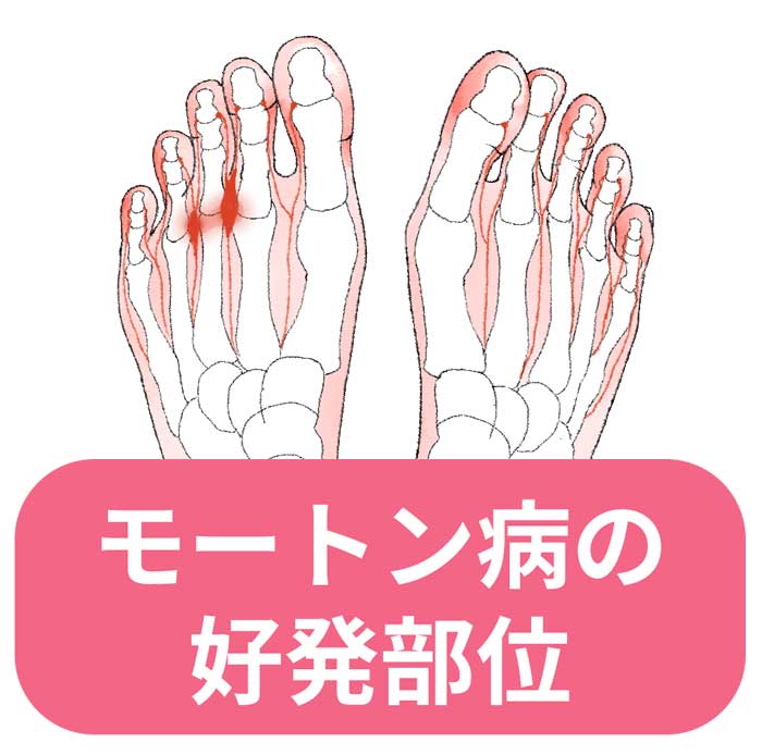 足の裏や足指の付け根の痛み